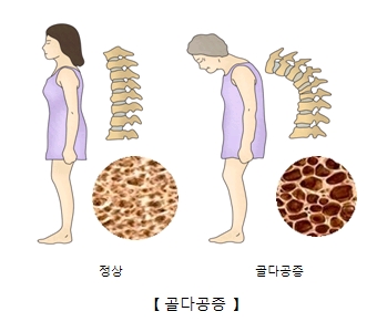50대 60대 필독! 뼈 ‘숭숭’ 뚫리는 골다공증, ‘이것’ 안 먹으면 평생 후회합니다! (우유, 멸치, 두부, 햇볕)